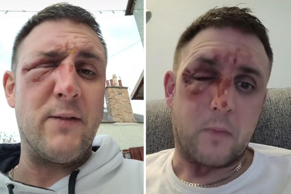 VIDEO // Un bărbat a ajuns la spital cu arsuri grave pe față, după ce a testat în bucătărie un truc viral pe Tiktok